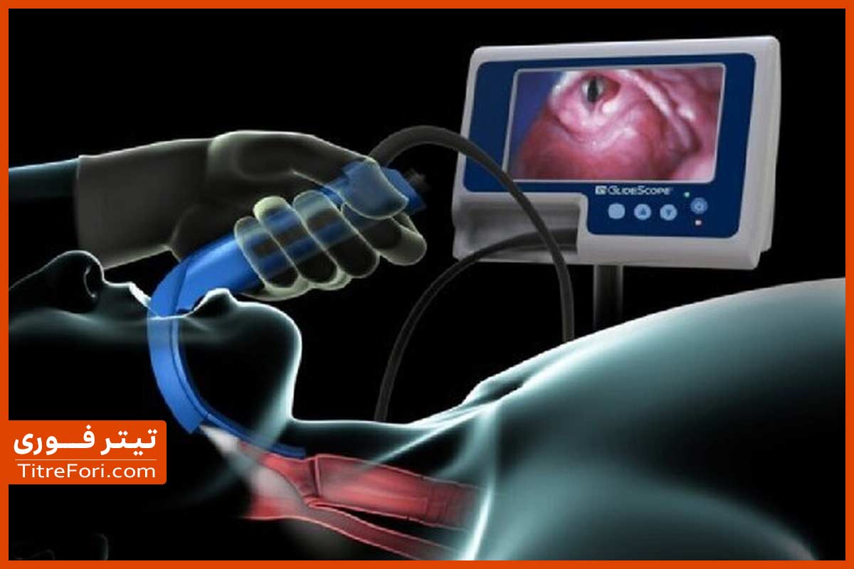 اینتوبه چیست و برای کدام بیماران استفاده میشود ؟