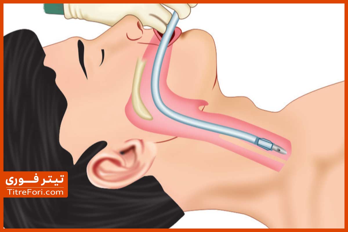 اینتوبه چیست و برای کدام بیماران استفاده میشود ؟